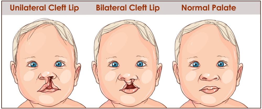 Types of Cleft Palate vs. Typical Palate