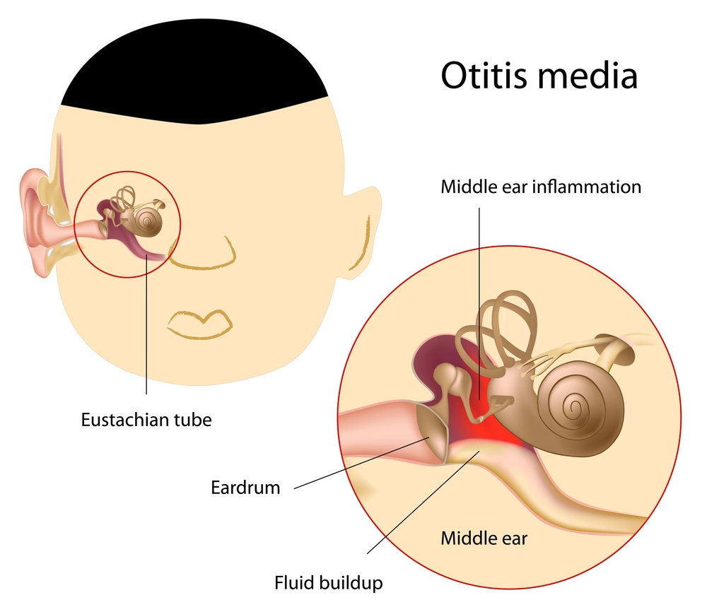 Otitis Media or Glue Ear