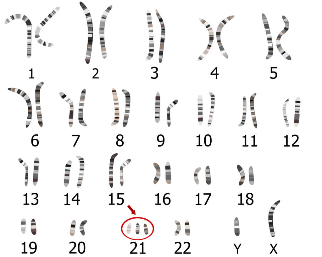 Down syndrome - third copy of the 21st chromosome